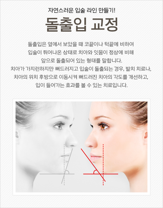 돌출입교정